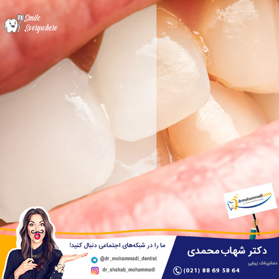 بلیچینگ دندان چیست و چگونه انجام می شود؟ - کلینیک دندانپزشکی دکتر شهاب محمدی